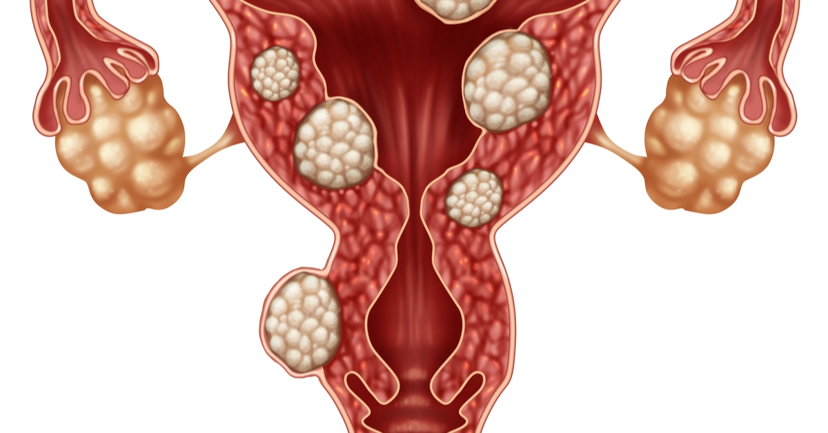 أورام الرحم الليفية